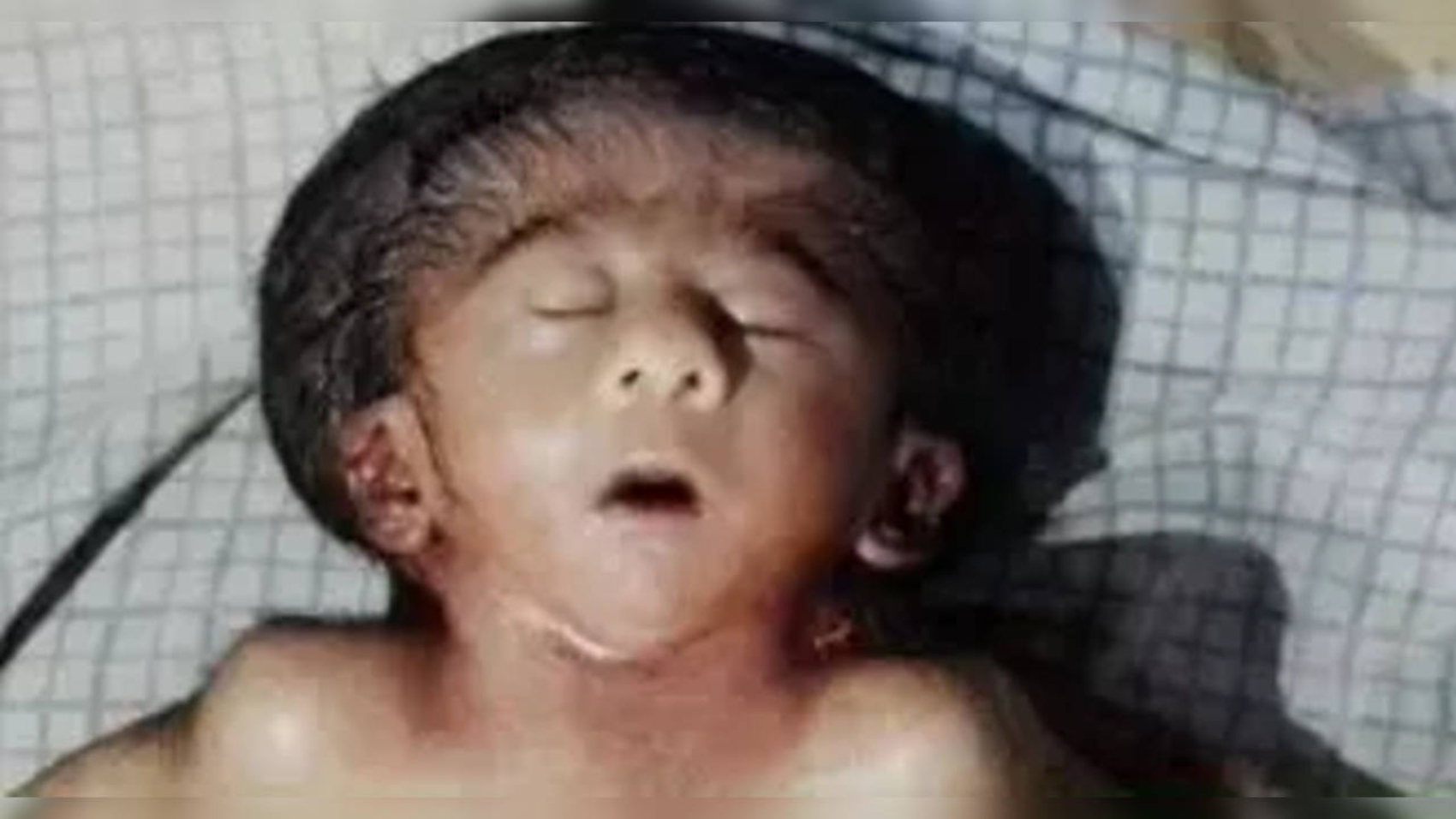 Biharban született csecsemő 4 kart, 4 lábat és 2 szívet